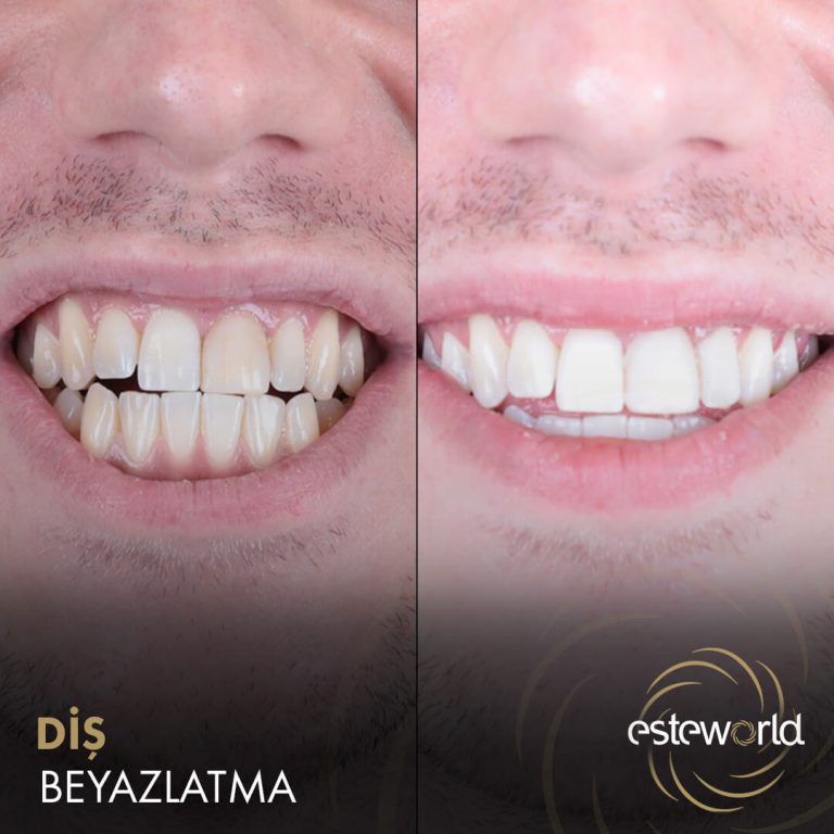 Diş Beyazlatma - 1