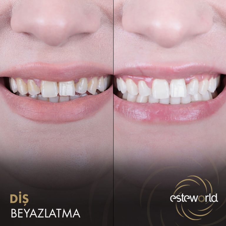 Diş Beyazlatma - 2