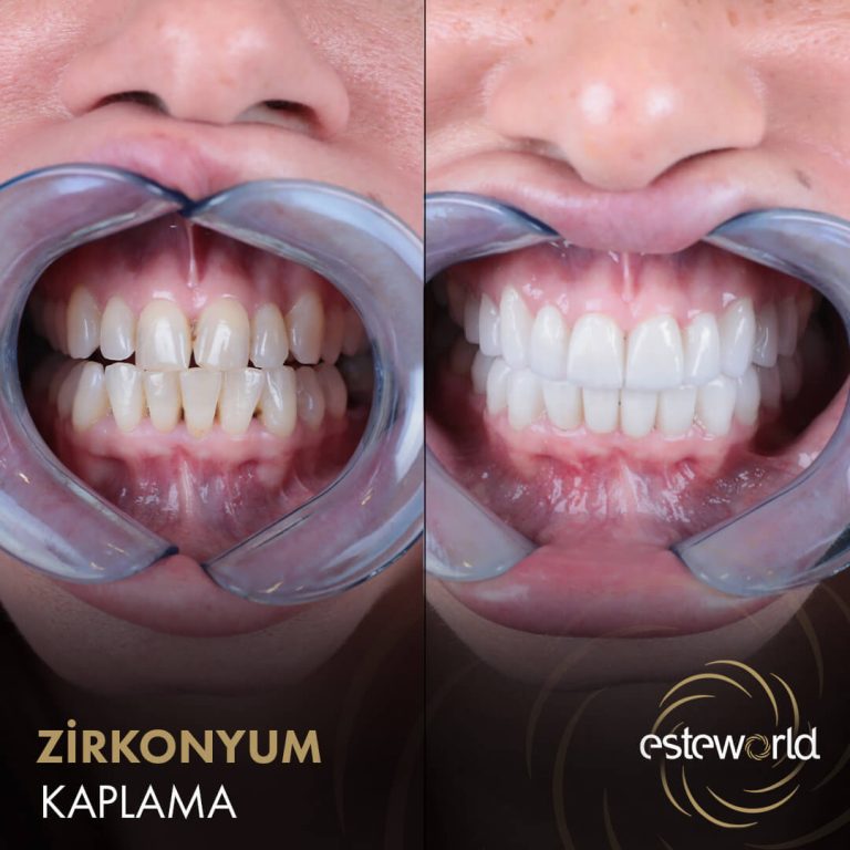 Zirkonyum Kaplama - 1