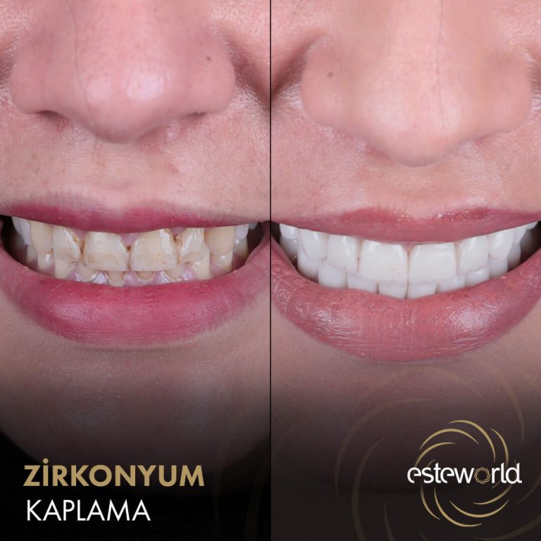 Zirkonyum Kaplama - 2