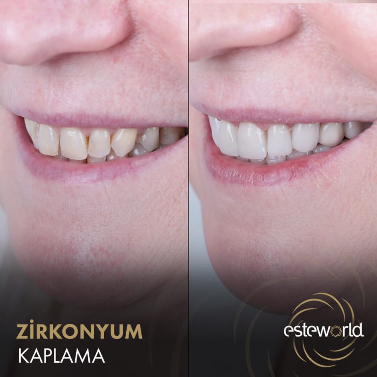 Zirkonyum Kaplama - 3