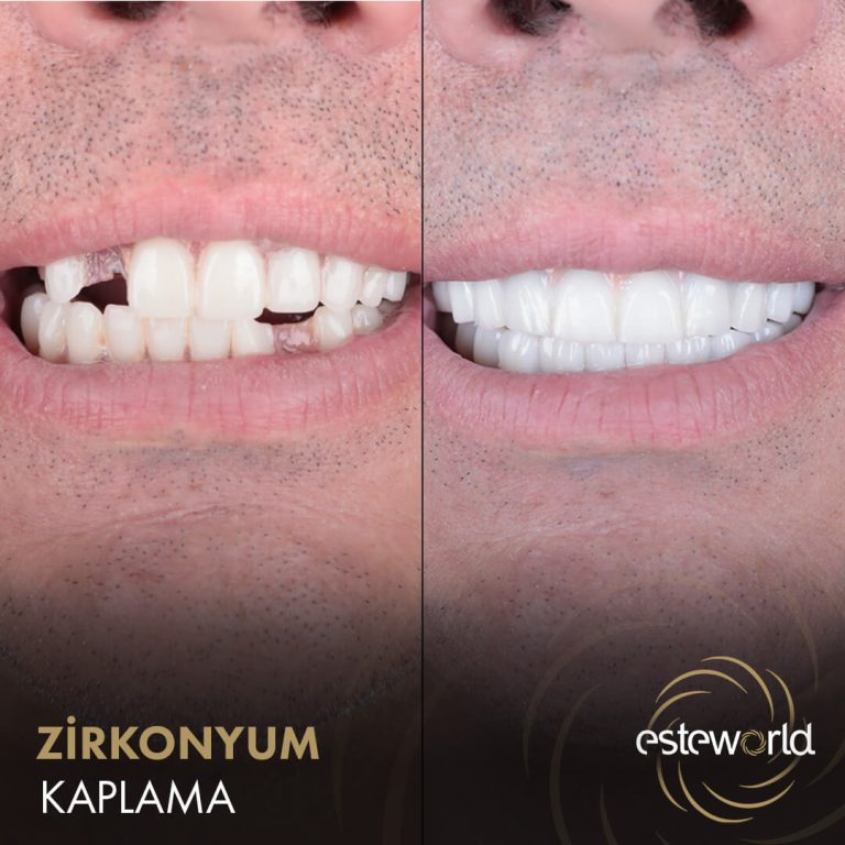 Zirkonyum Kaplama - 4