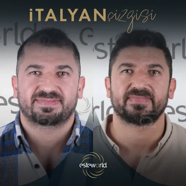 İtalyan Çizgisi - BA - 11