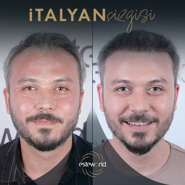 İtalyan Çizgisi - BA - 15