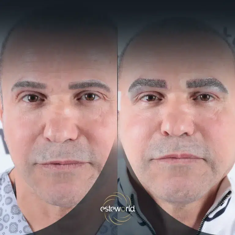 eyebrow-before-after0