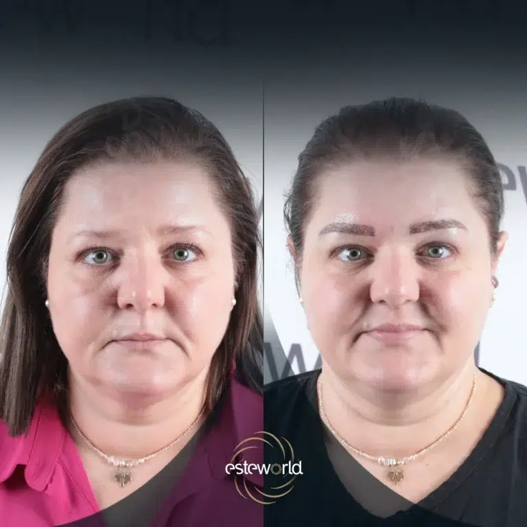 eyebrow-before-after1