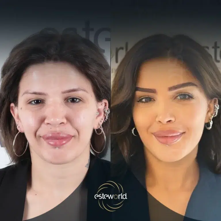 eyebrow-before-after10