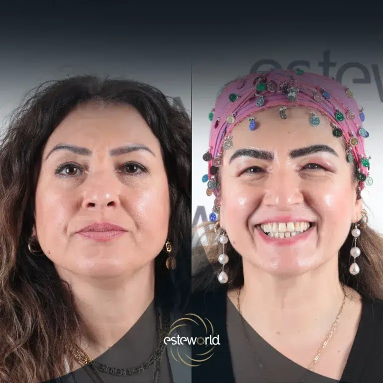 eyebrow-before-after12