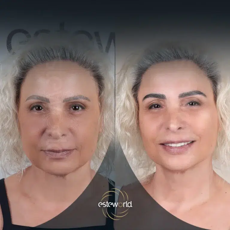 eyebrow-before-after2