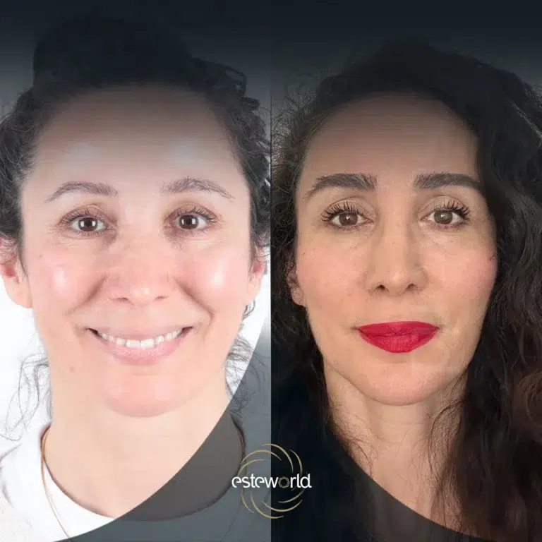 eyebrow-before-after3