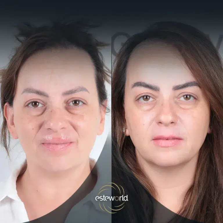 eyebrow-before-after5