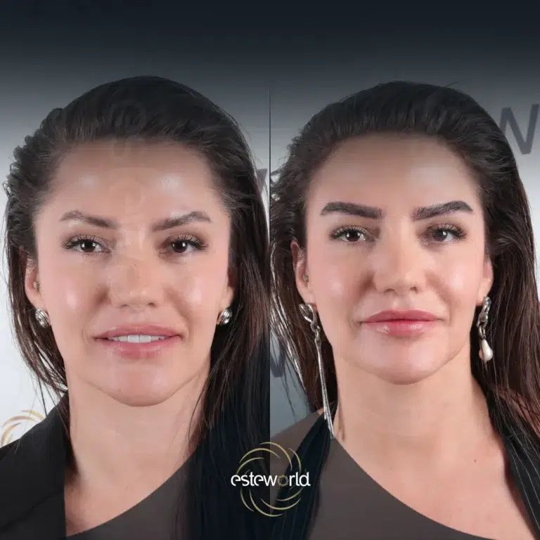 eyebrow-before-after6