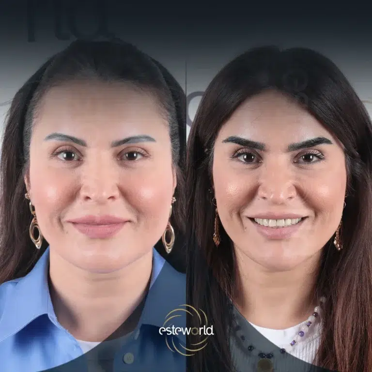 eyebrow-before-after7