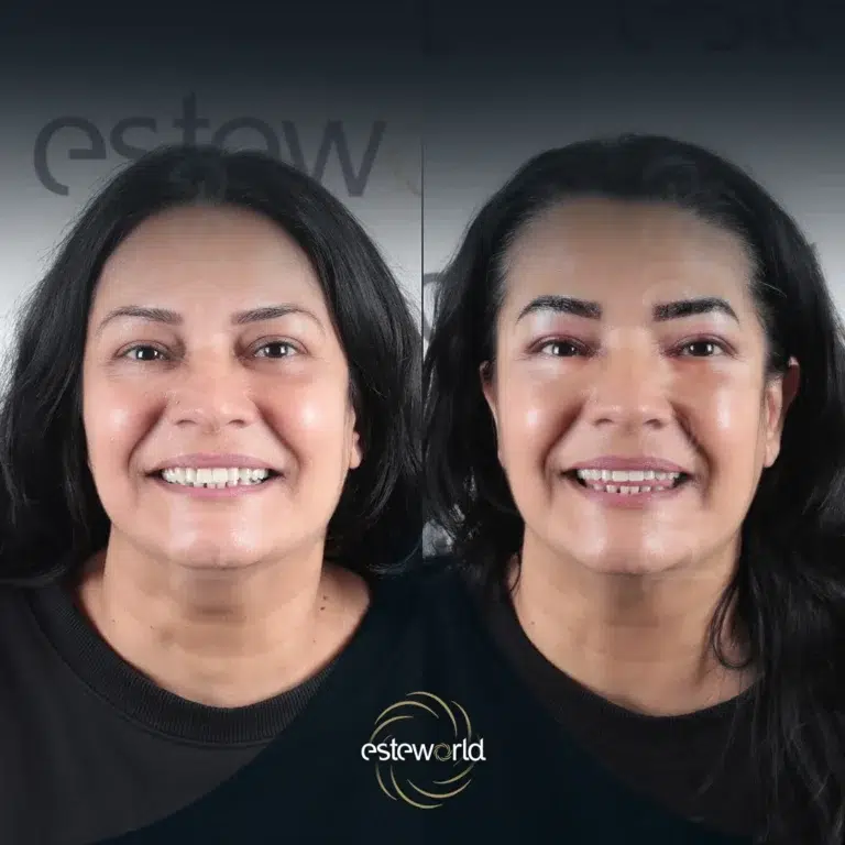 eyebrow-before-after8