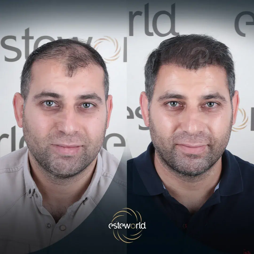 hair-before-after1-1