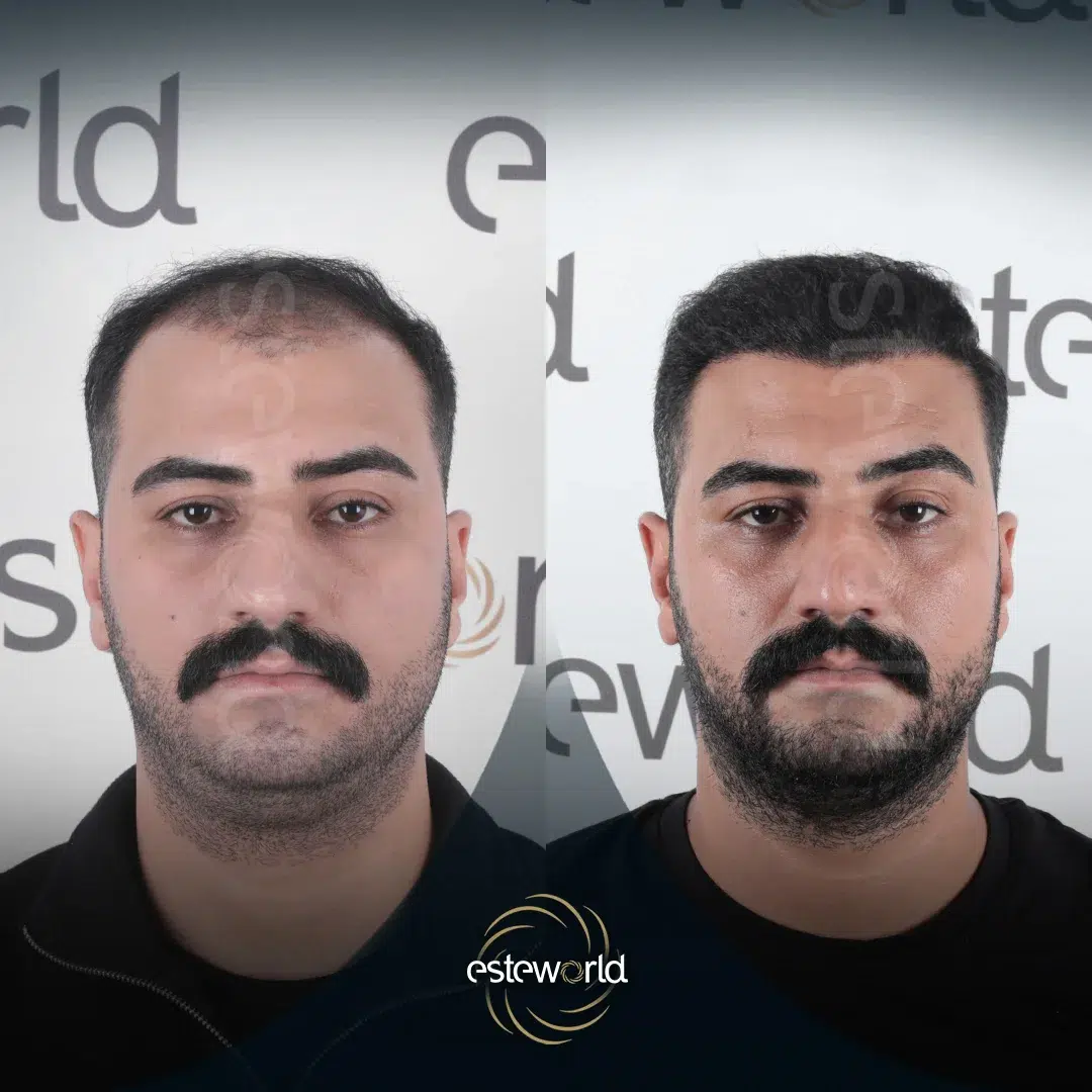 hair-before-after10-1