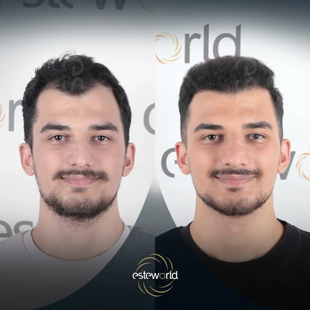 hair-before-after11-1