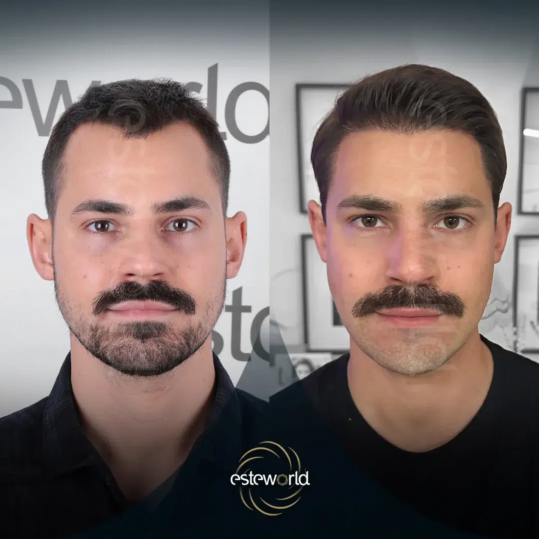 hair-before-after12-1