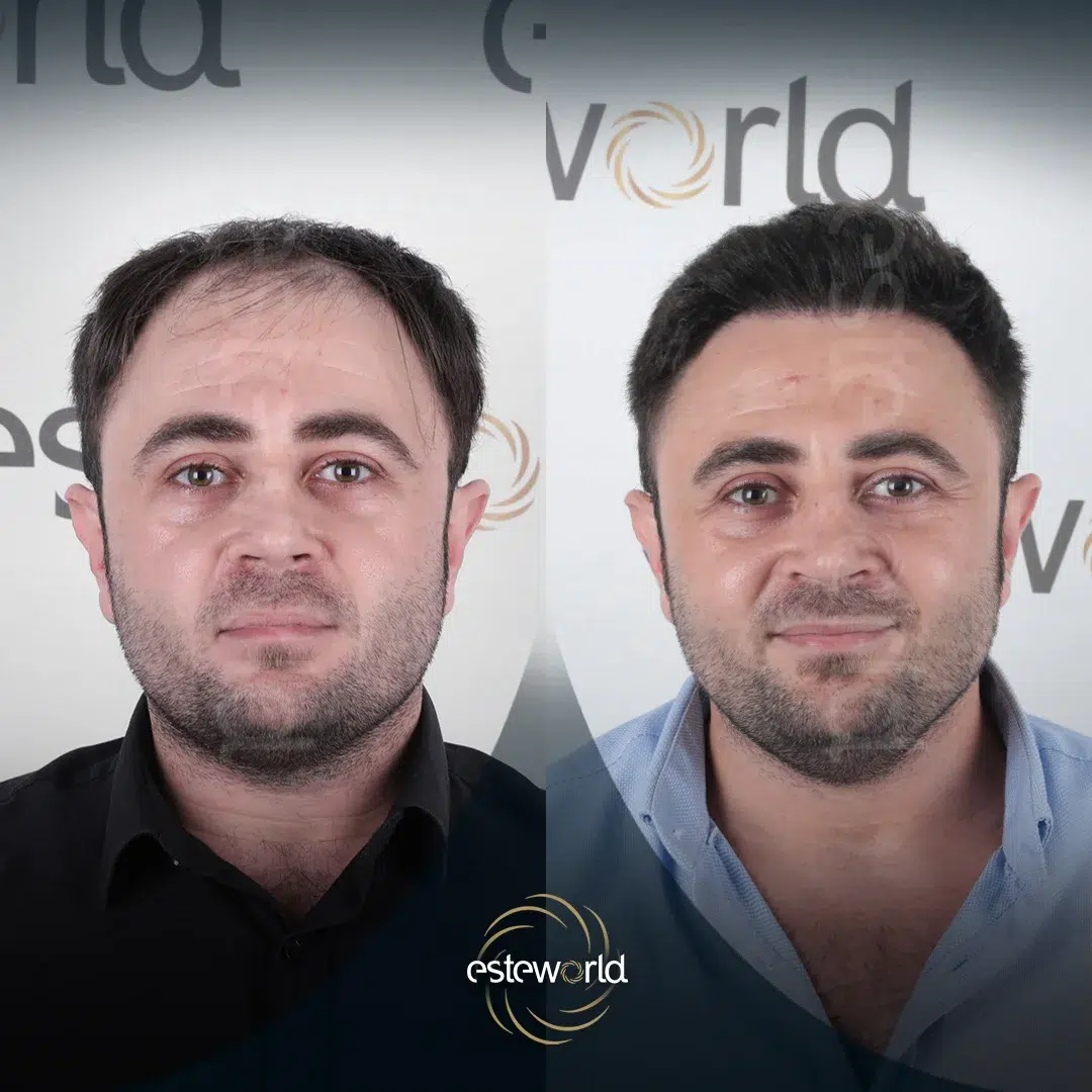 hair-before-after13-1