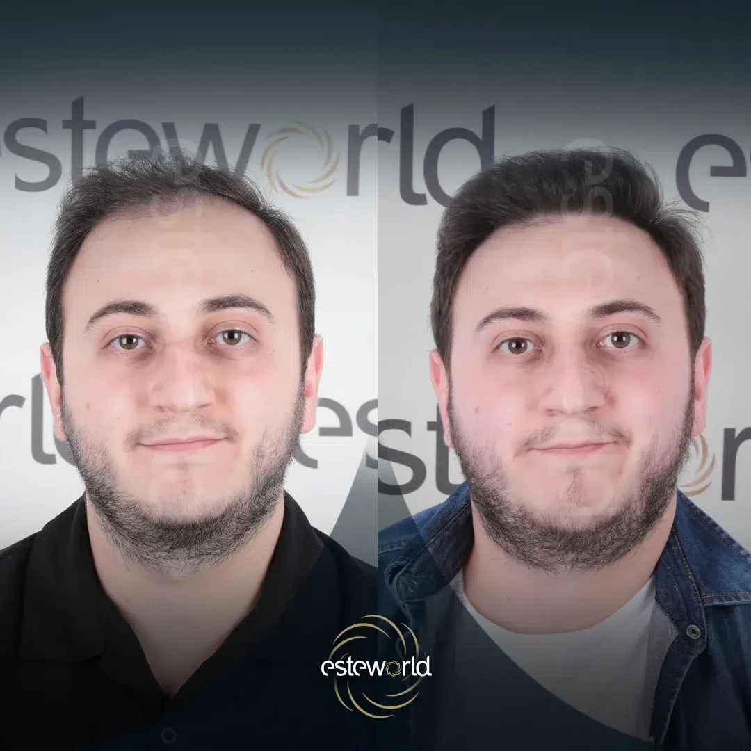 hair-before-after14-1