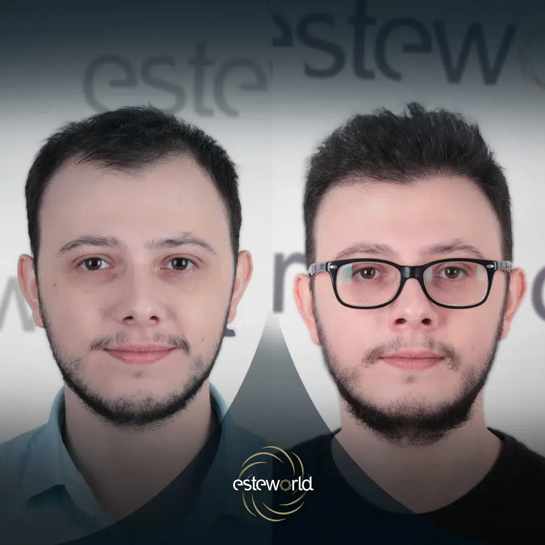 hair-before-after15-1