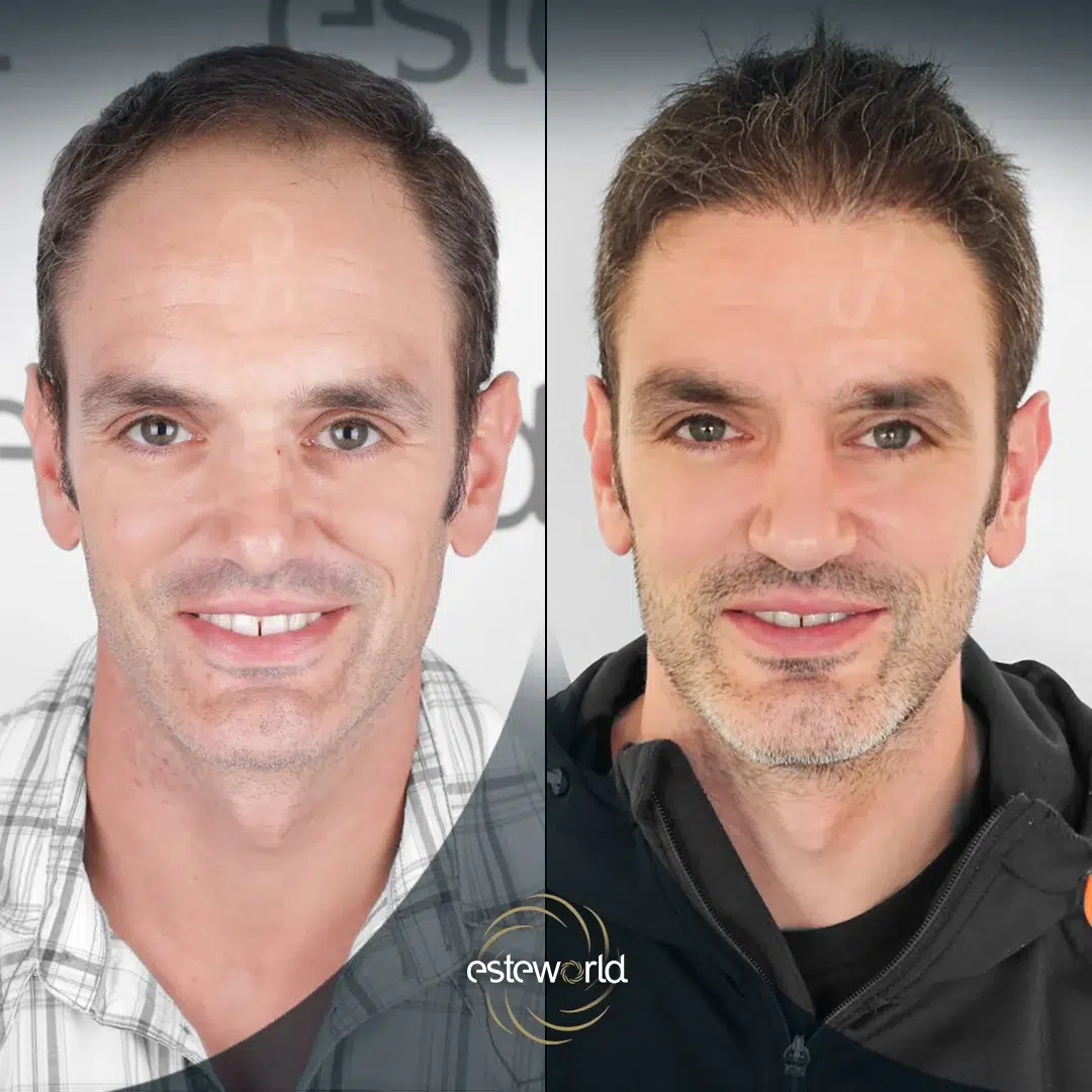 hair-before-after16-1