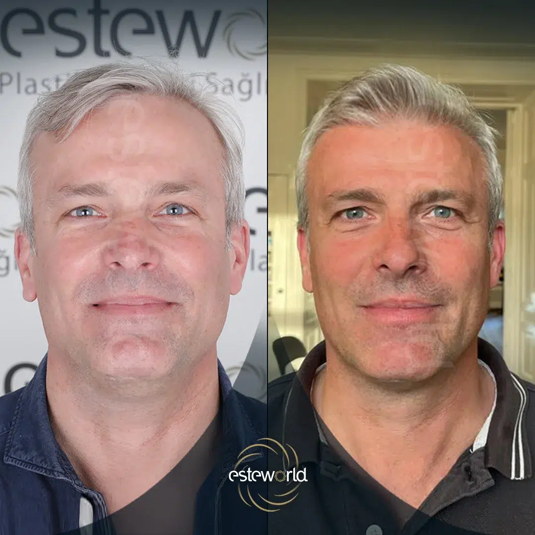 hair-before-after17-1