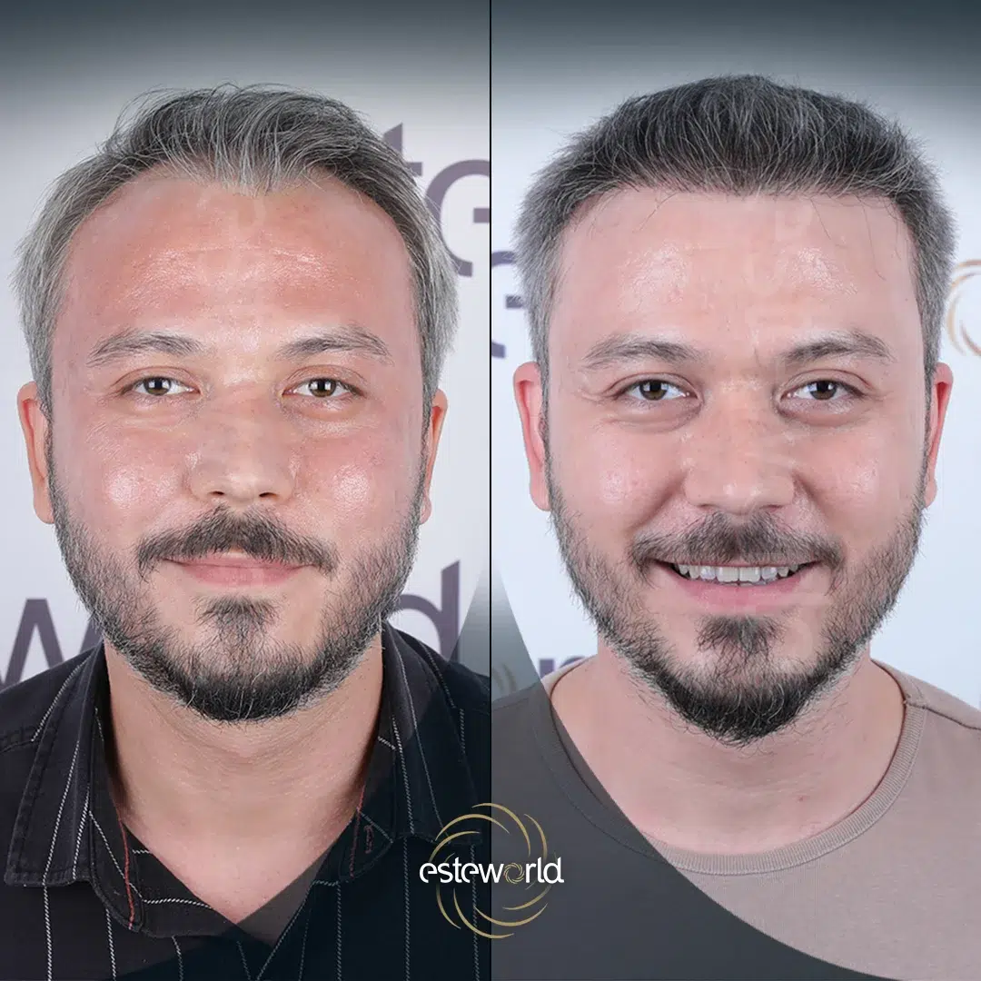 hair-before-after18-1