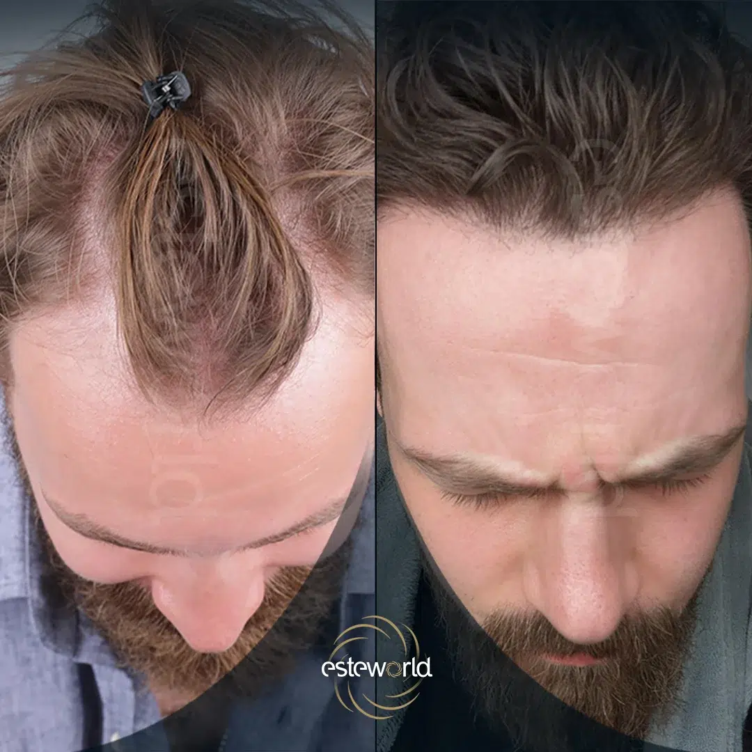 hair-before-after19-1