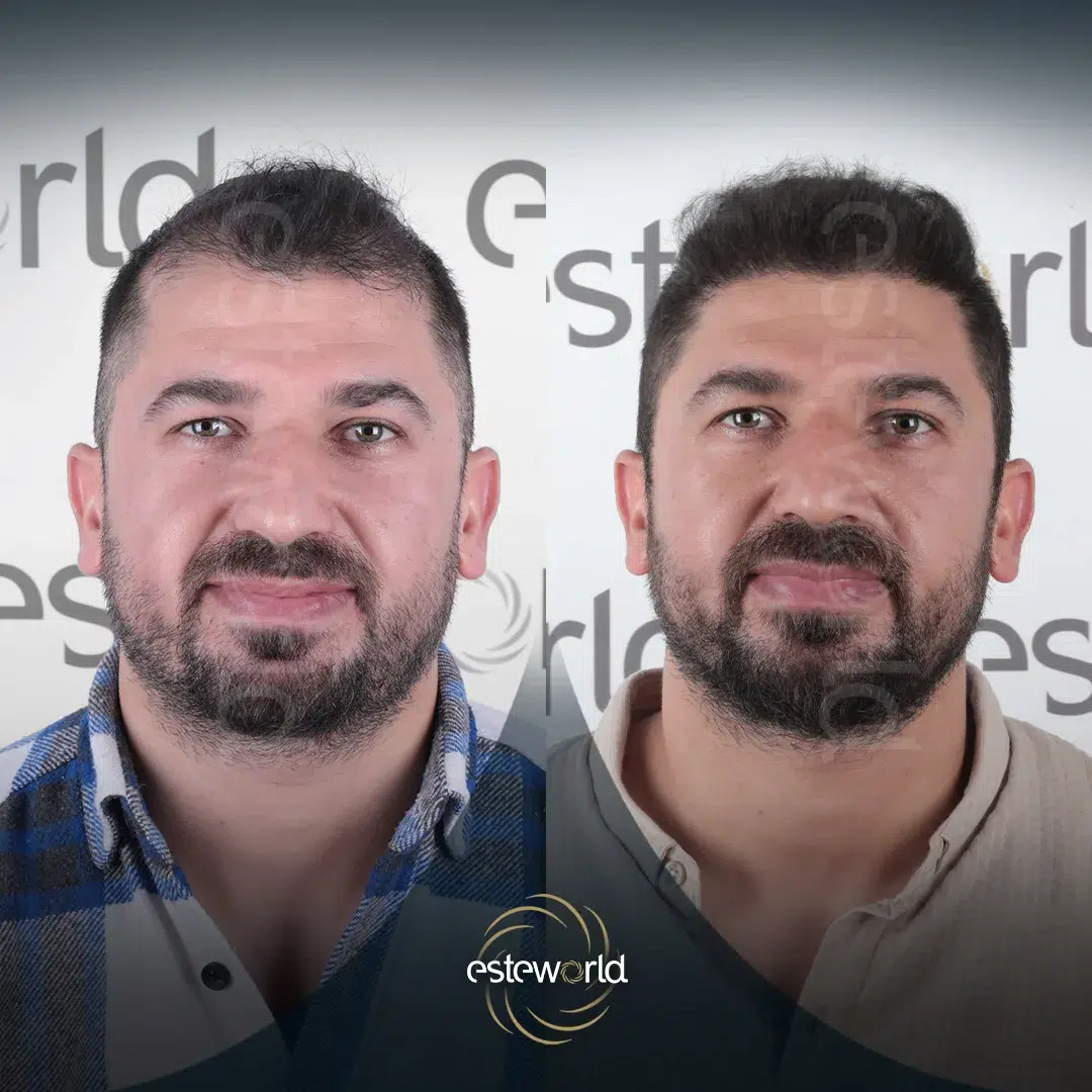 hair-before-after2-1