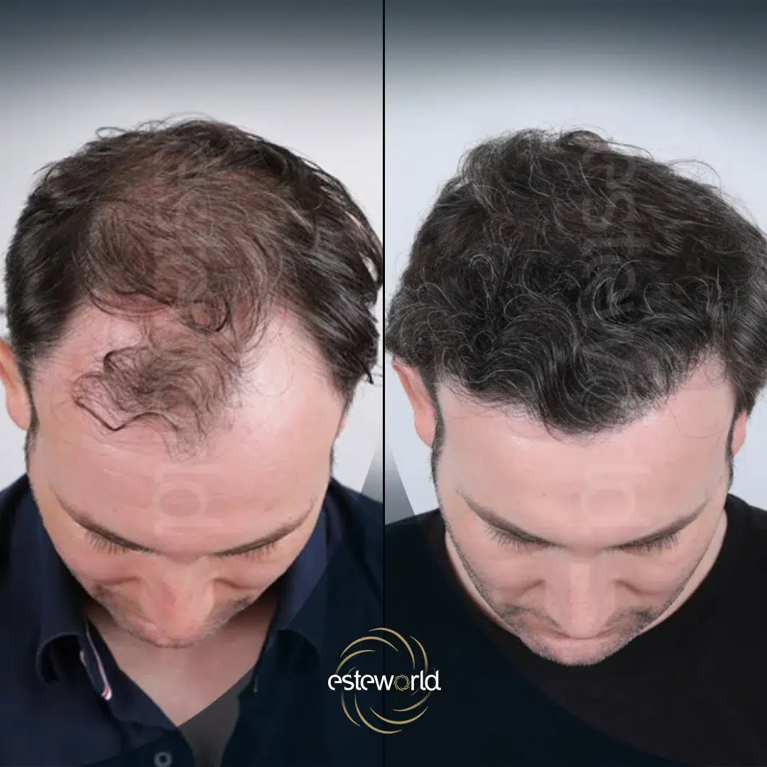 hair-before-after21-1