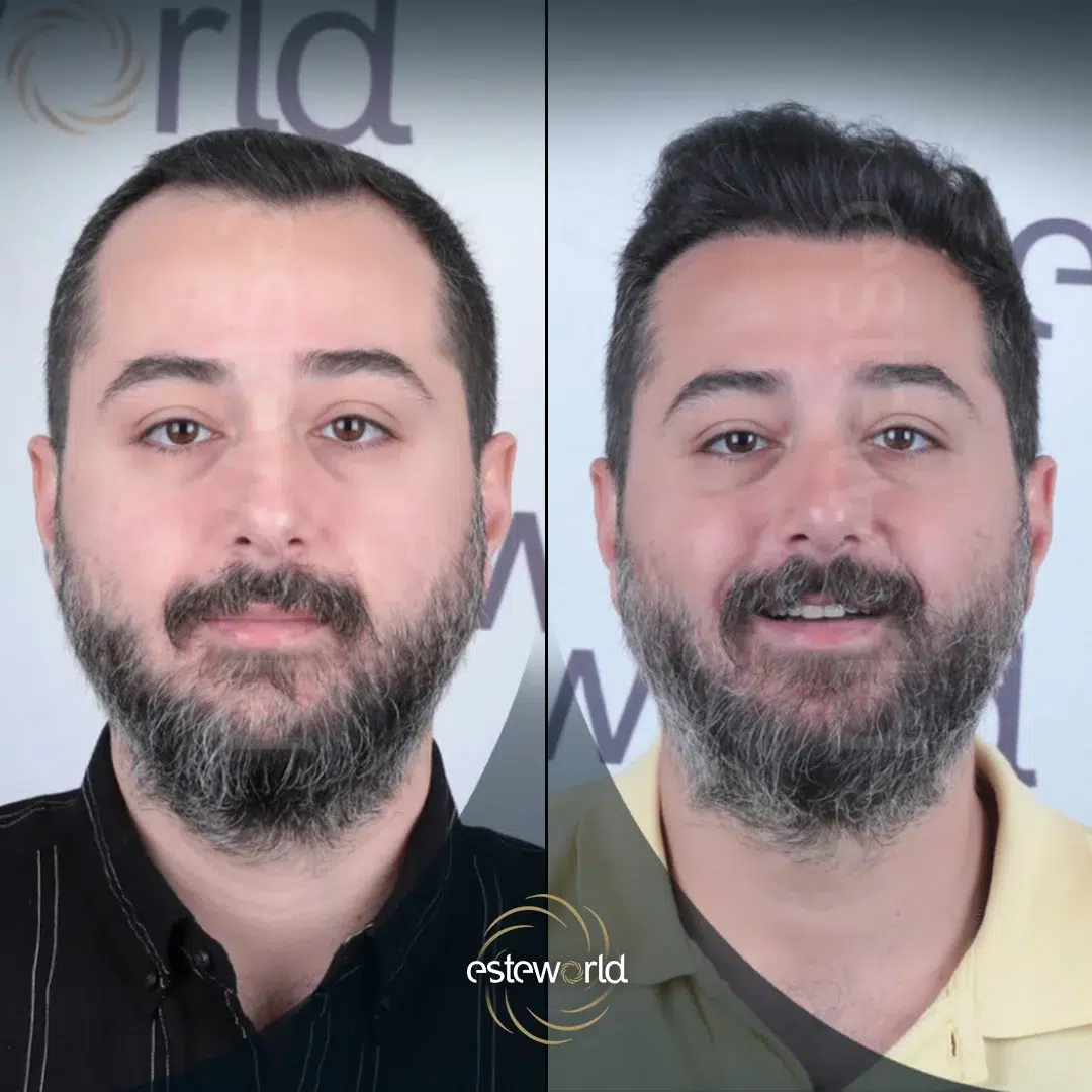 hair-before-after23-1