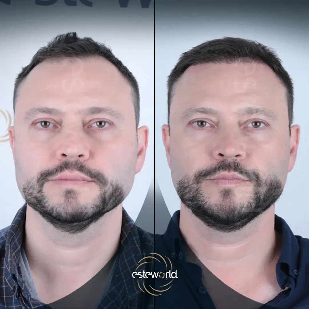 hair-before-after24-1