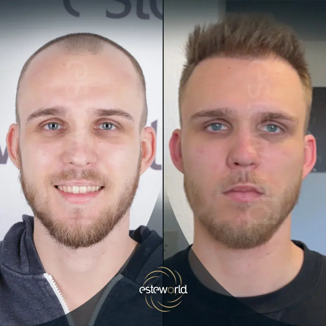 hair-before-after26-1