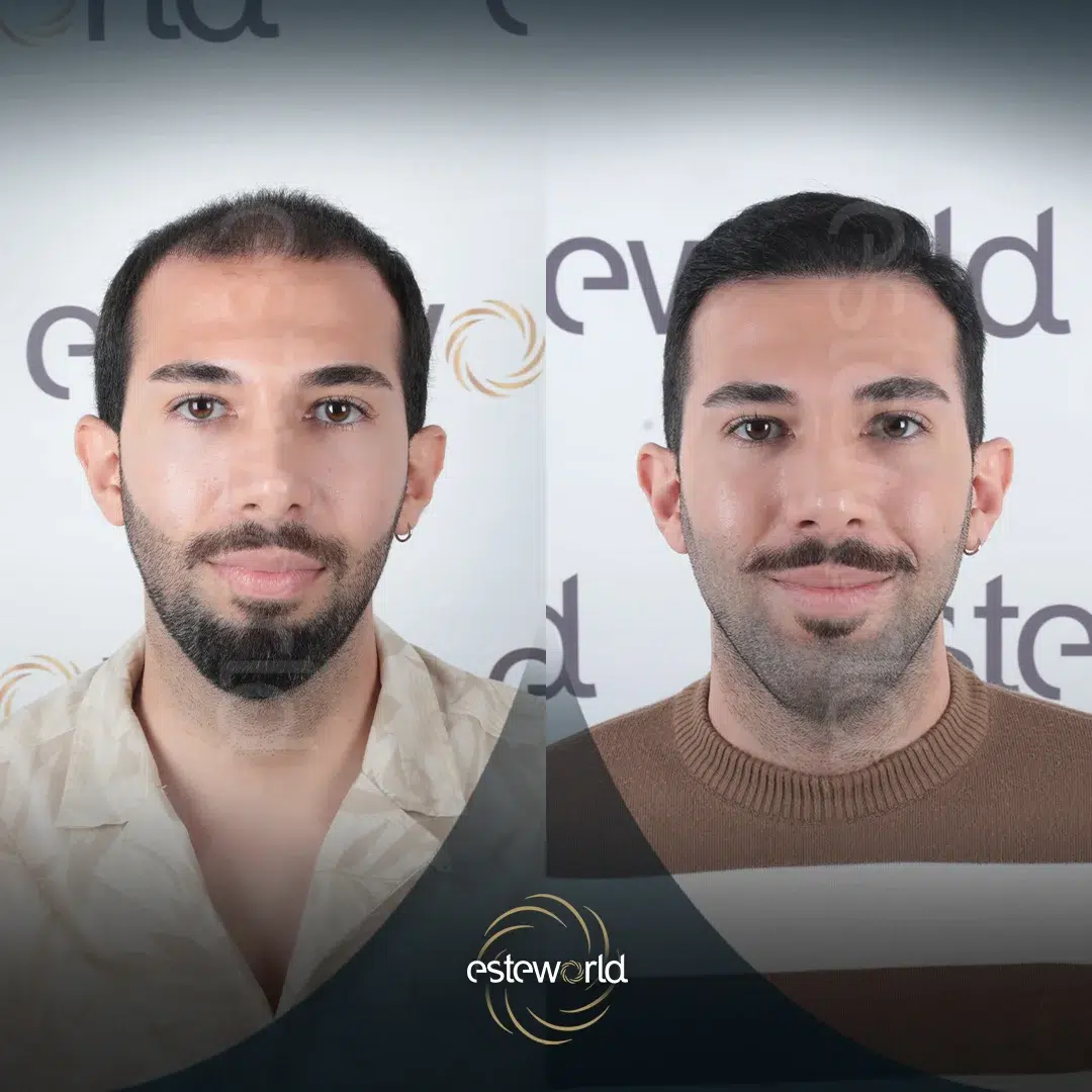 hair-before-after27-1