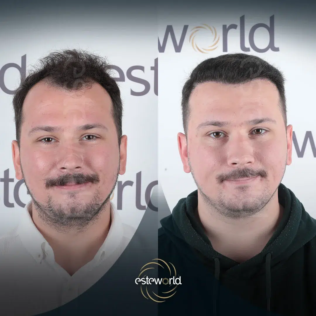 hair-before-after28-1