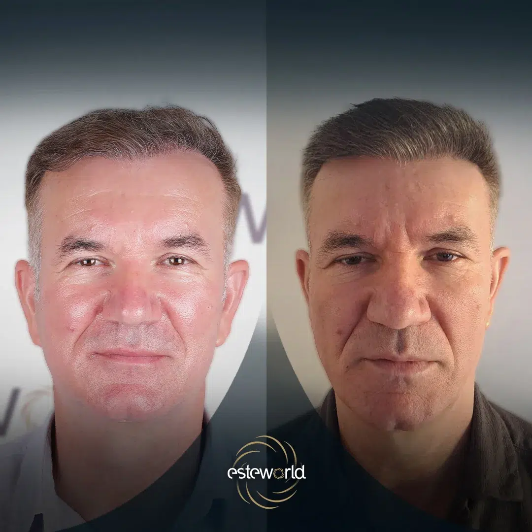 hair-before-after29-1