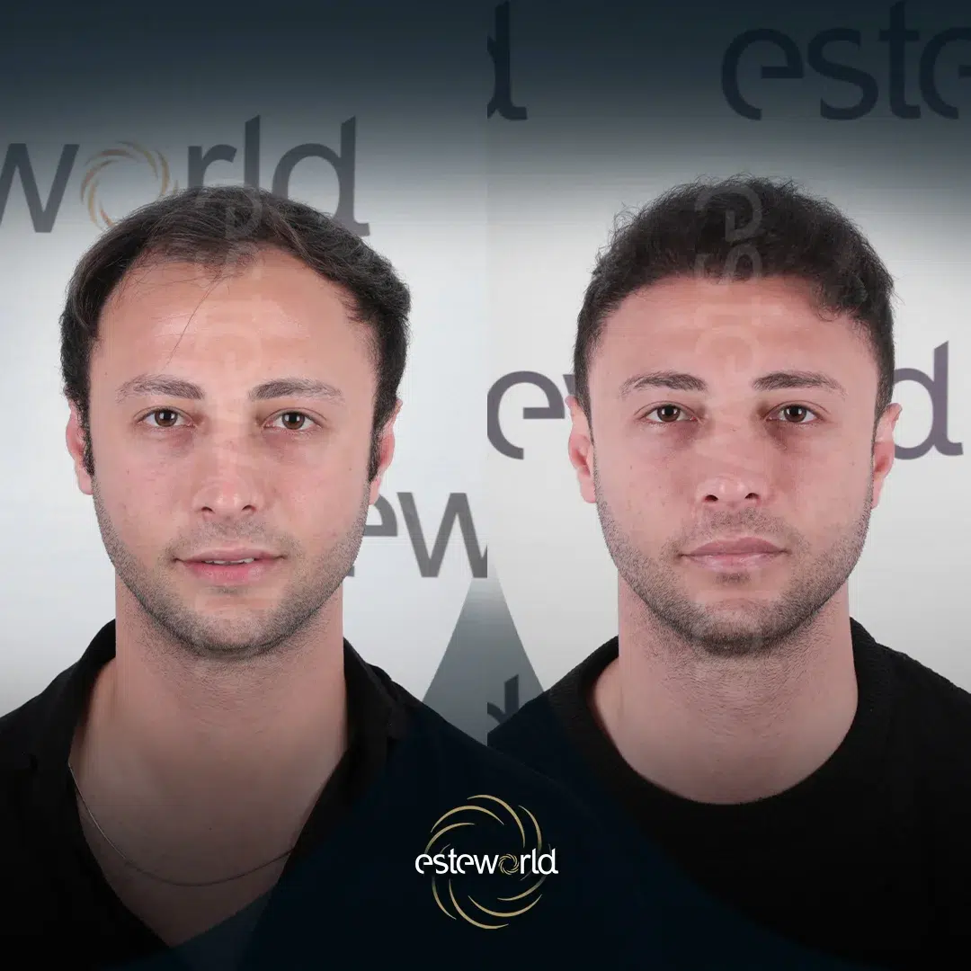 hair-before-after3-1