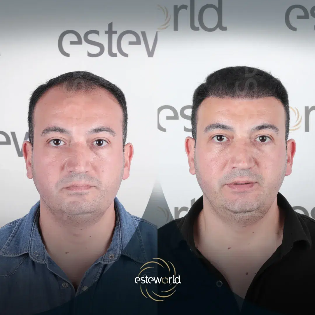 hair-before-after4-1