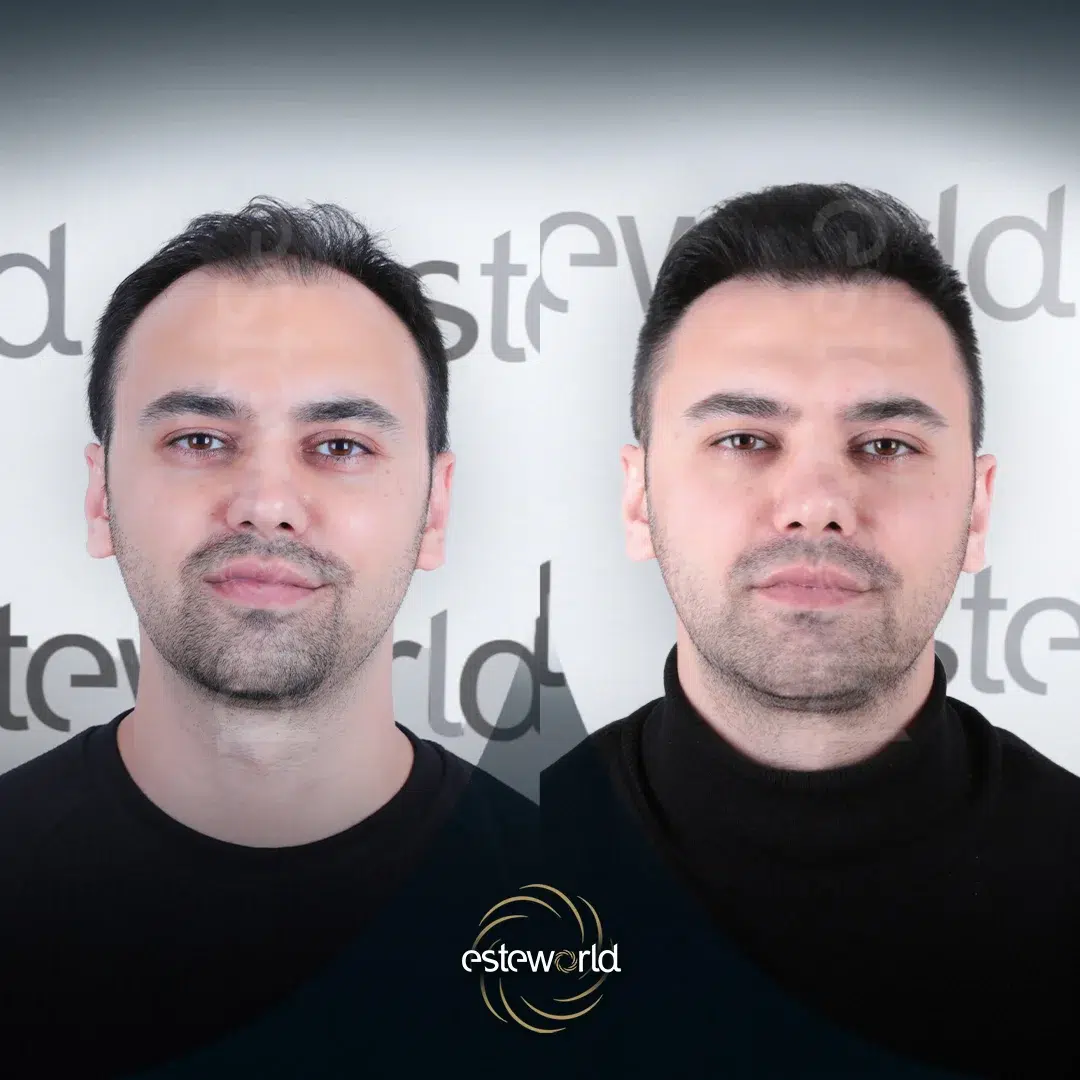 hair-before-after5-1