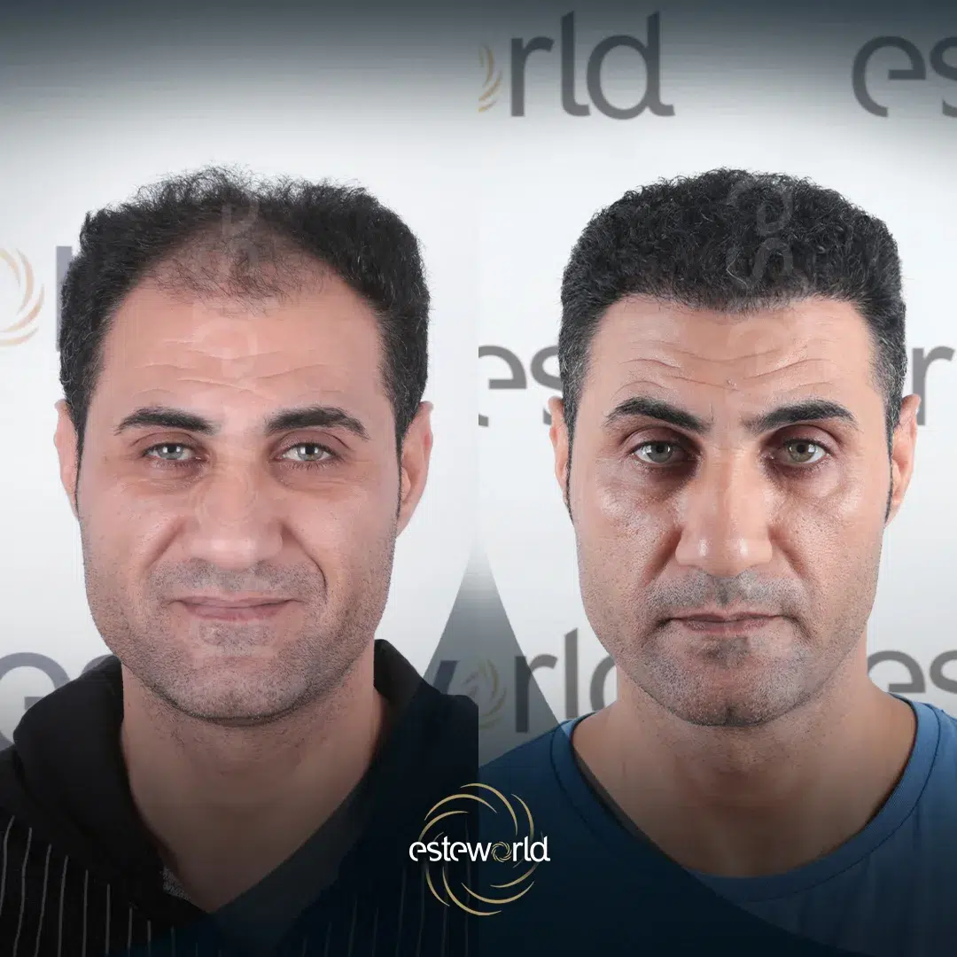 hair-before-after7-1