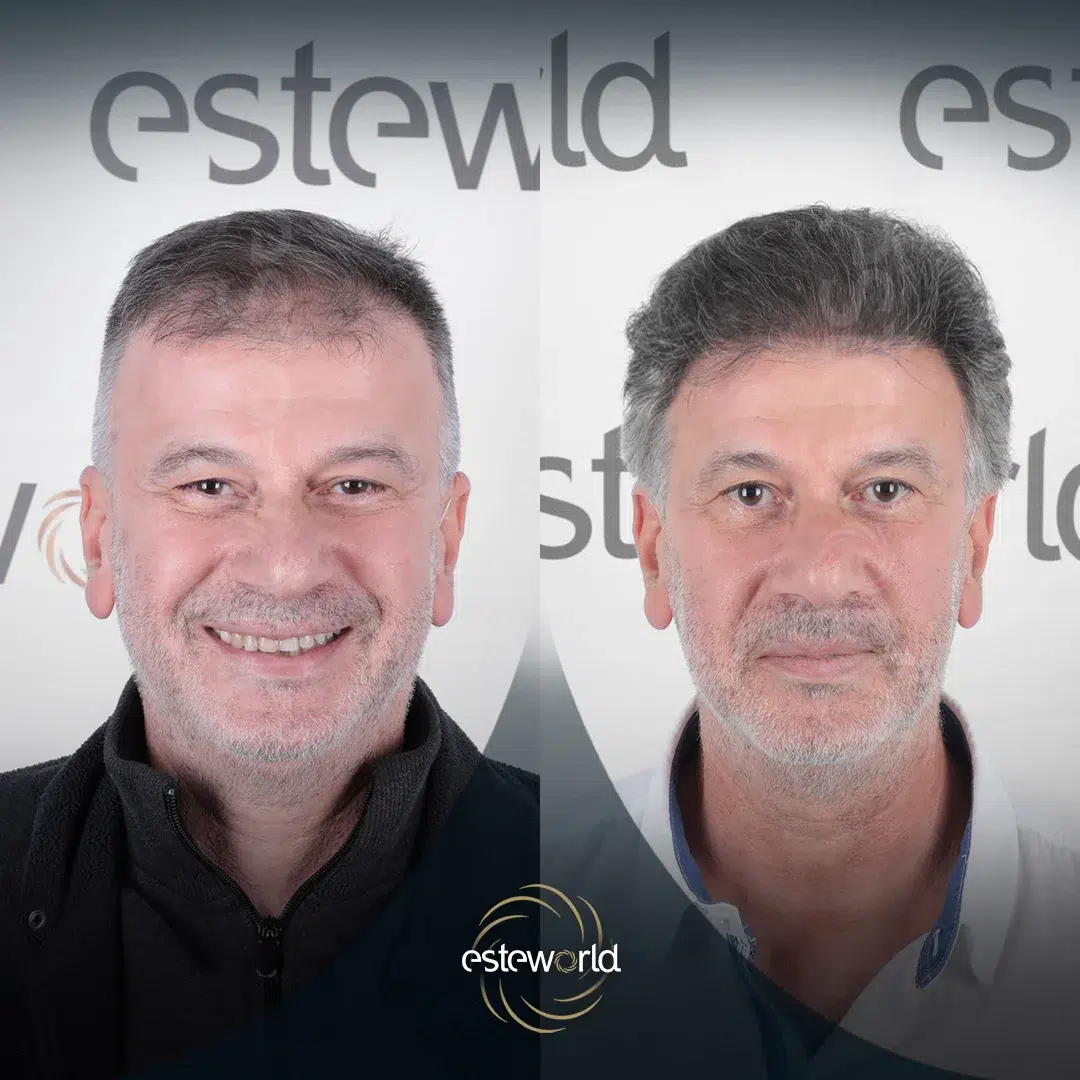 hair-before-after8-1
