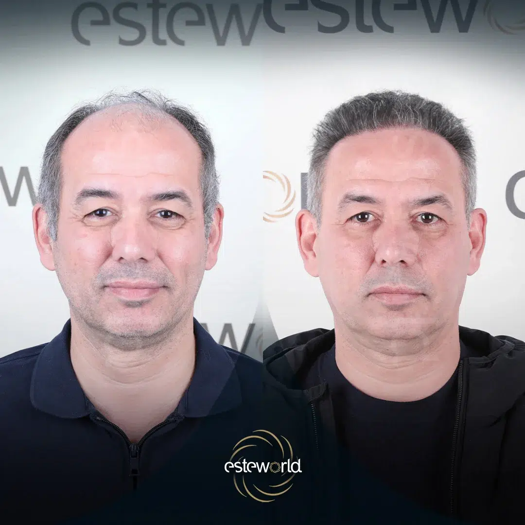 hair-before-after9-1