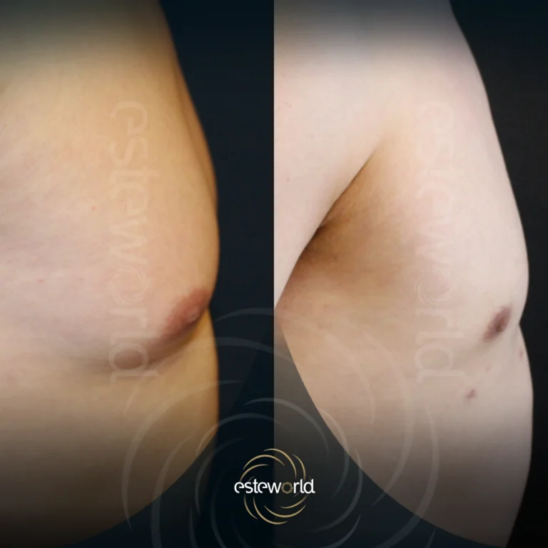 jinekomasti-before-after0