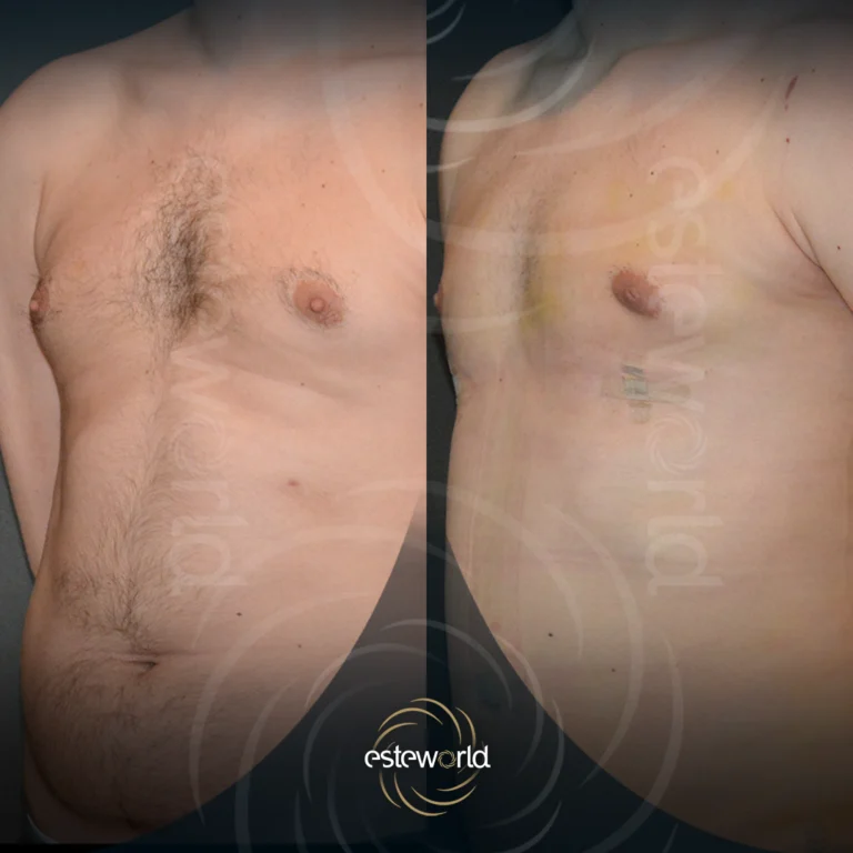 jinekomasti-before-after1