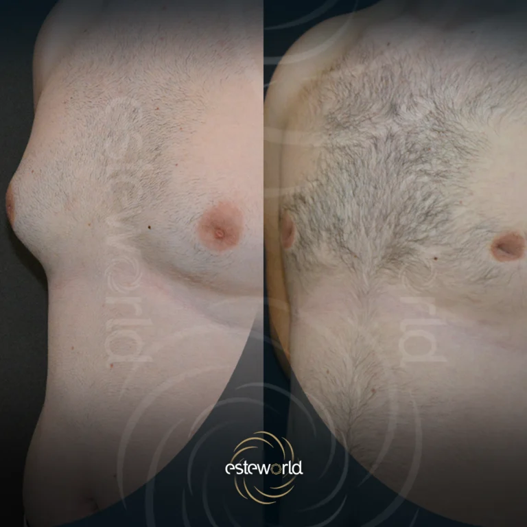 jinekomasti-before-after2