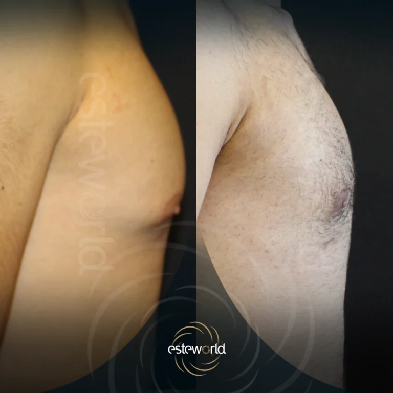 jinekomasti-before-after3