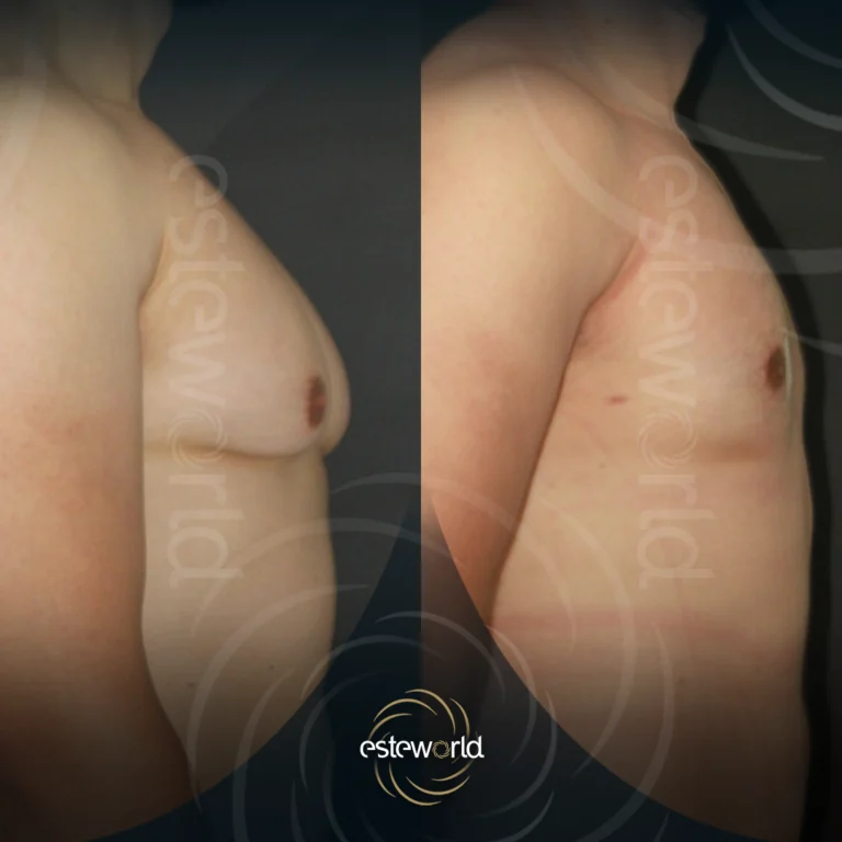 jinekomasti-before-after4