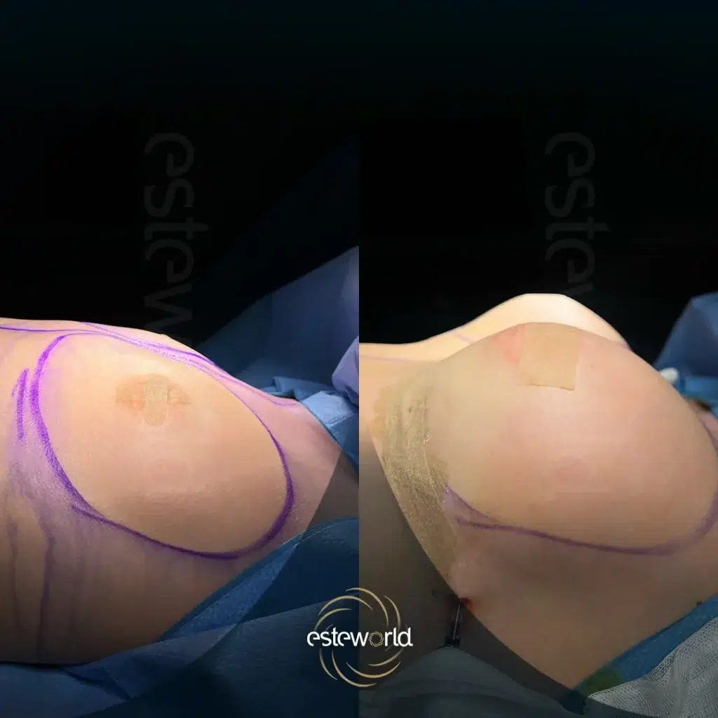 breast-before-after10.webp