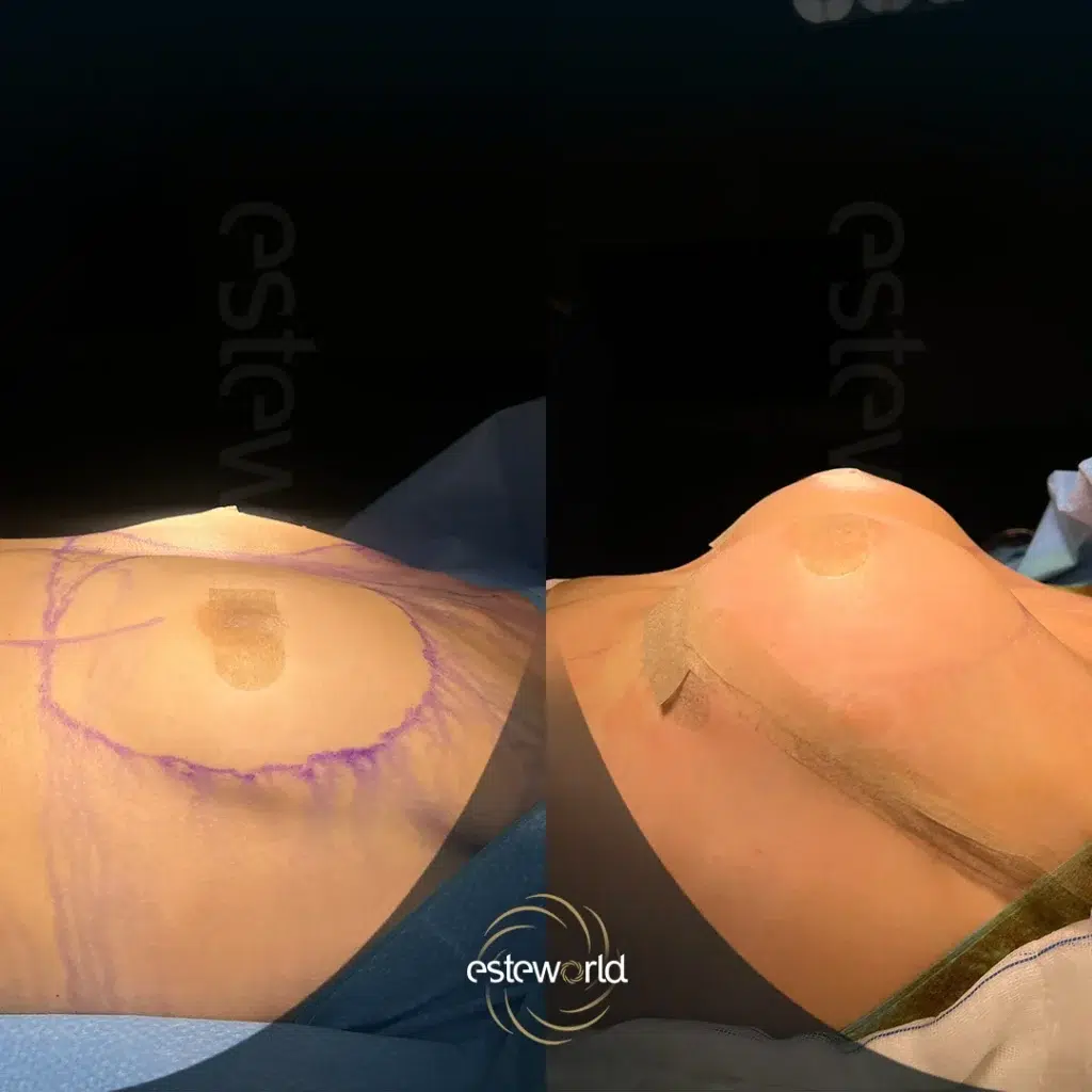 breast-before-after12.webp